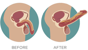 Before and After Blood Flow